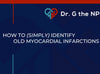 How to (Simply) Identify Old Myocardial Infarctions Guide
